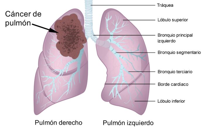 La inteligencia artificial y el cáncer pulmón
